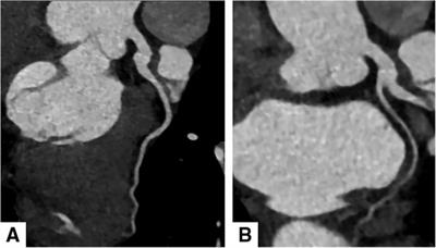 Case report: Braid-like right coronary artery with chest pain